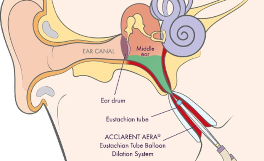 What Is ETD (Eustachian Tube Dysfunction)?